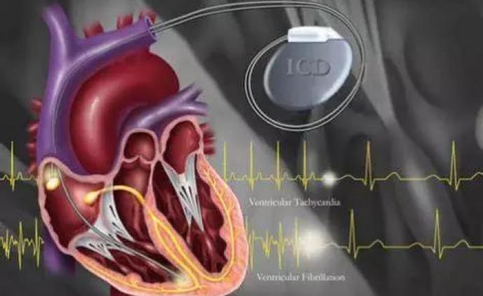 最新起搏器,最新起搏器，重塑心脏健康的新希望